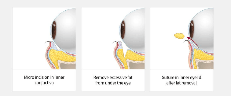 transconjunctival eye bag removal procedure steps