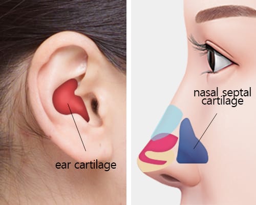 ear cartilage rhinoplasty