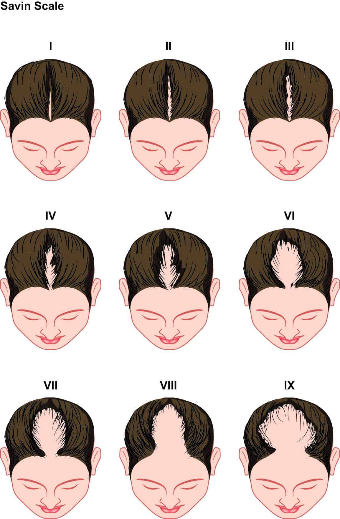 Hair Loss Treatment In Singapore - Dream Plastic Surgery