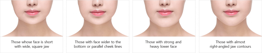 Jaw Reduction Surgery Singapore - Dream Plastic Surgery