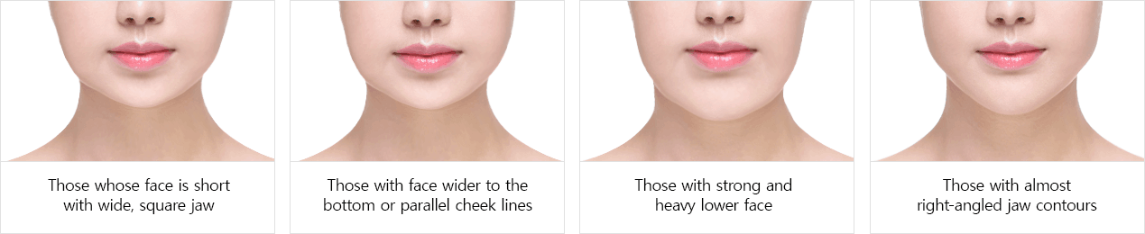 Jaw Reduction Surgery Singapore - Dream Plastic Surgery