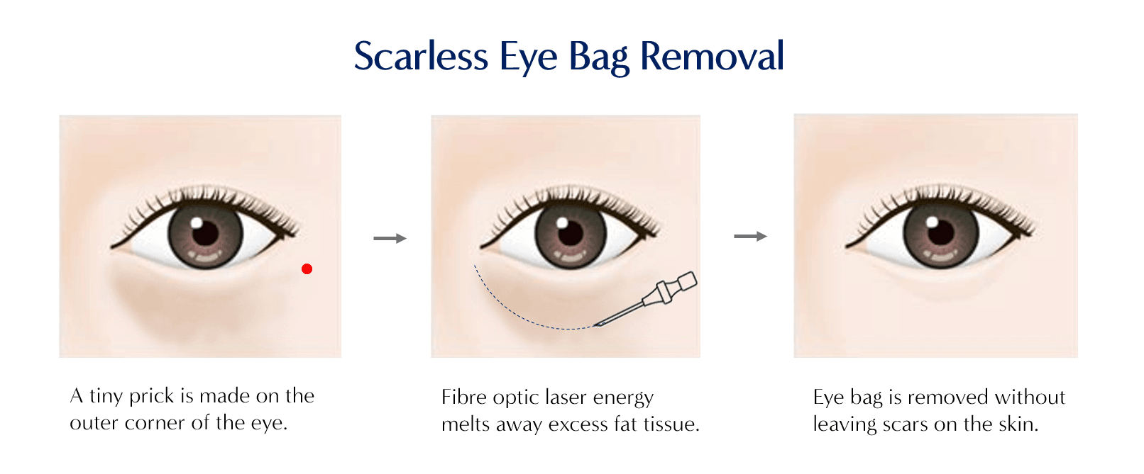 scarless eye bag removal procedure steps - dream plastic surgery singapore