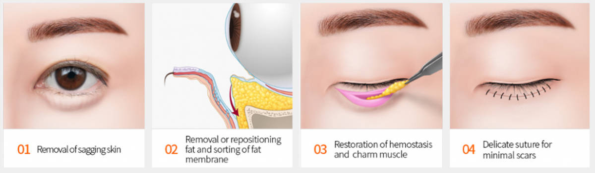 transconjuctival eye bag removal surgery procedure steps - dream plastic surgery singapore