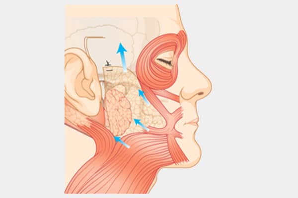 full face lift, traditional face lift - rhytidectomy - dream plastic surgery singapore