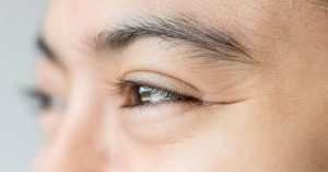 causes of eye bags and how remove them