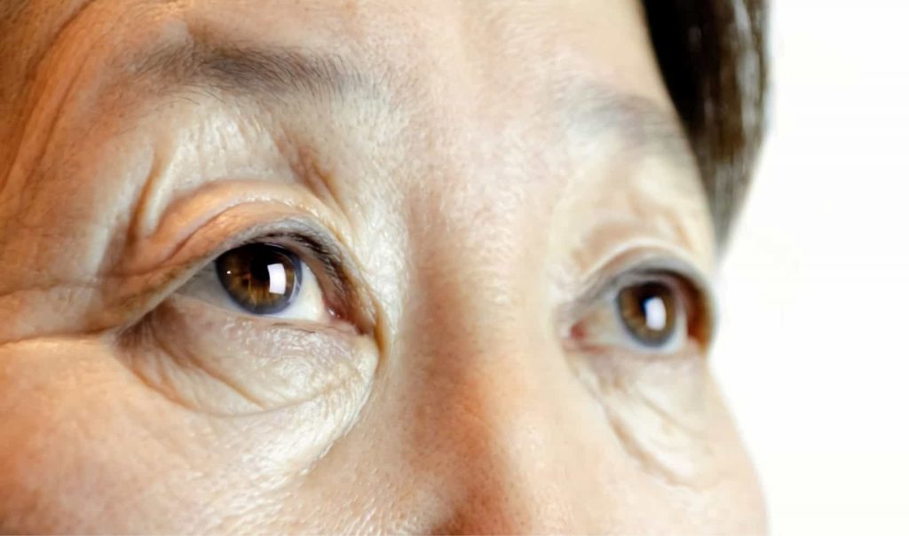 droopy eyelids elderly surgery