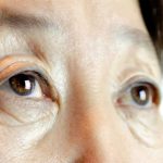 droopy eyelids elderly surgery