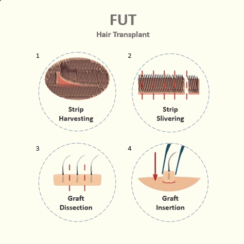 FUT procedure