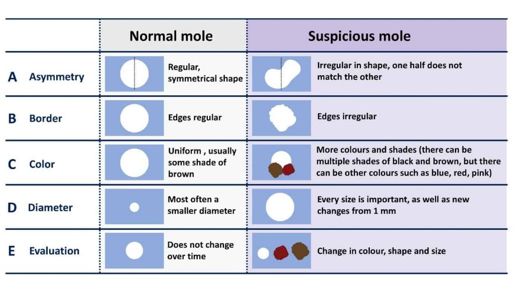 abcde mole assessment