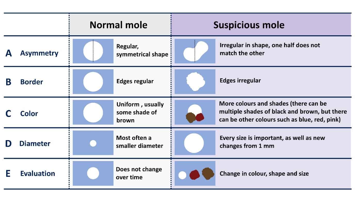 Identifying Suspicious Moles For Removal