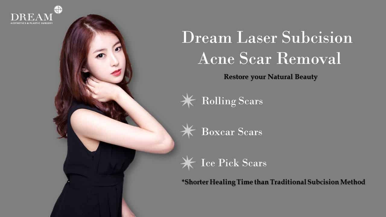Korean Laser subcision acne scar removal