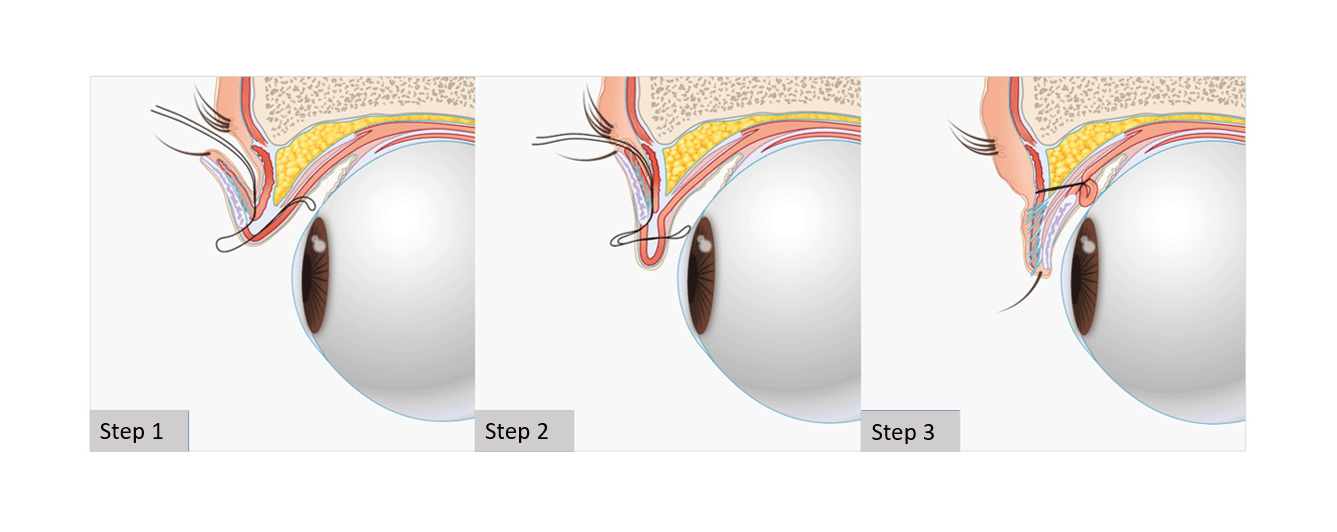 suture ptosis correction surgery singapore