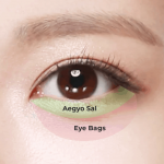 types of eye bag condition