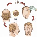 hair transplant method