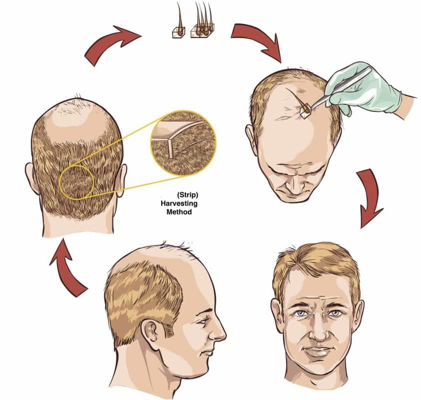 Are you a good candidate for Hair Transplant? - Dream Plastic Surgery