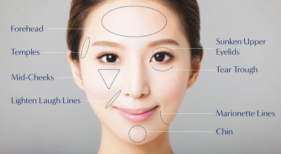 areas for facial fat grafting