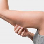 arm liposuction procedure - slimmer arms - permanent fat removal