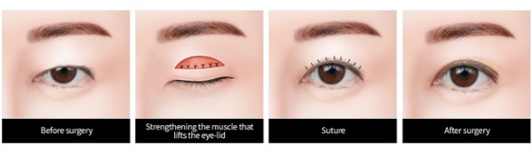 incisional ptosis correction surgery