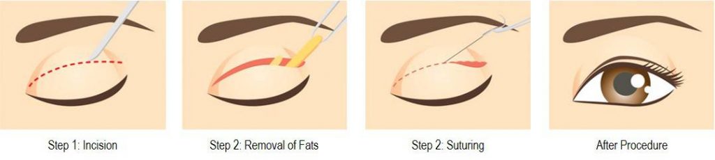 Incisional eyelid surgery