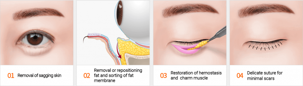 eye-bag-removal-surgery-for-the-elderly-is-it-recommended-dream