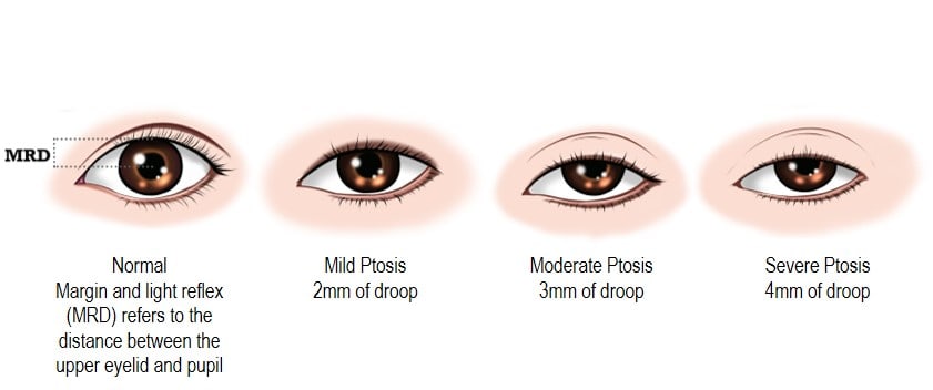 Ptosis Droopy Eyelid Causes Correction Treatment And Surgery Dream