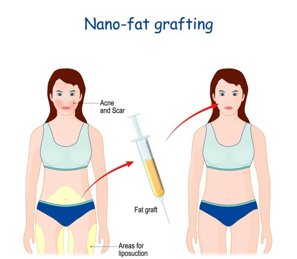 nano fat grafting diagram