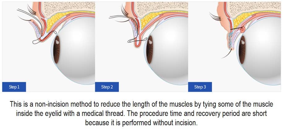 non incision ptosis correction