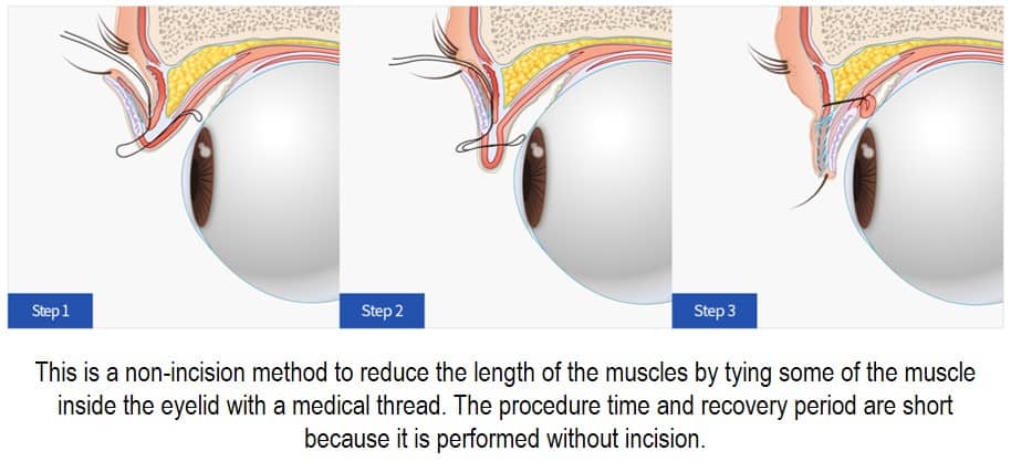 5 Ways to Get Rid of Under Eye Bags Without Surgery