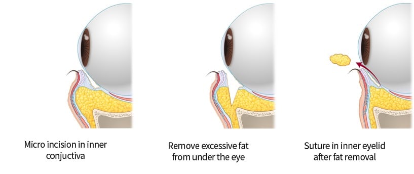 transconjuctival eye bag removal surgery method