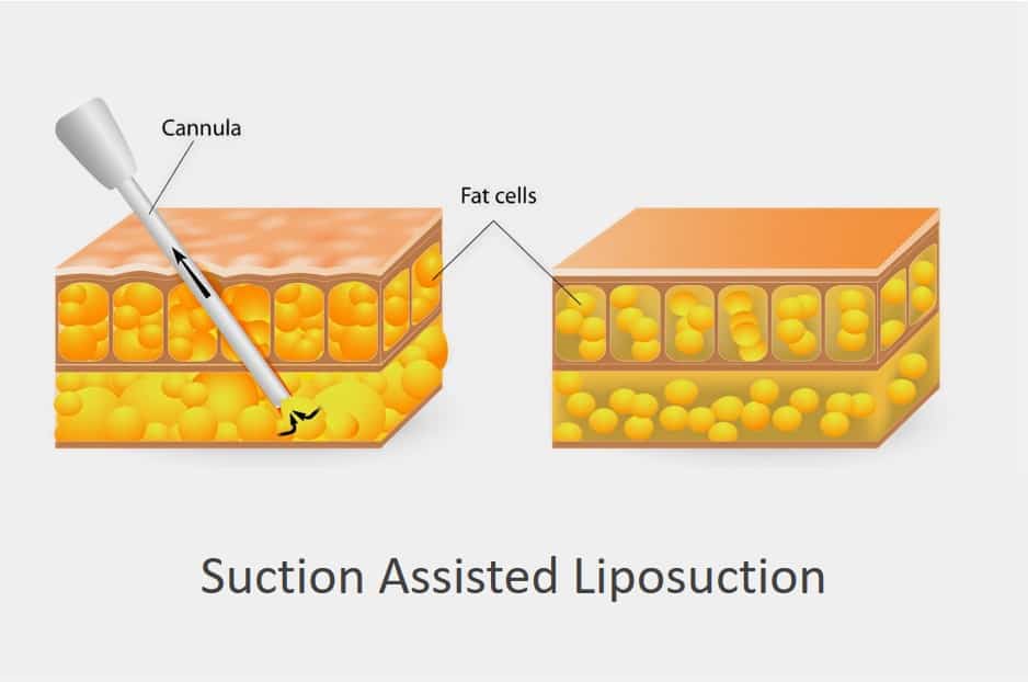 suction assisted liposuction surgery technique