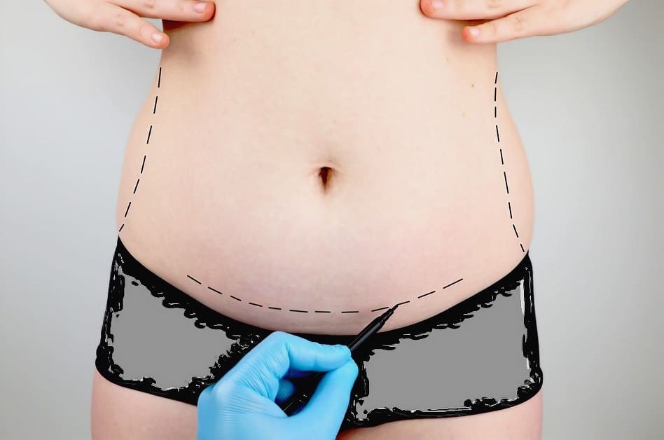 liposuction for body contouring