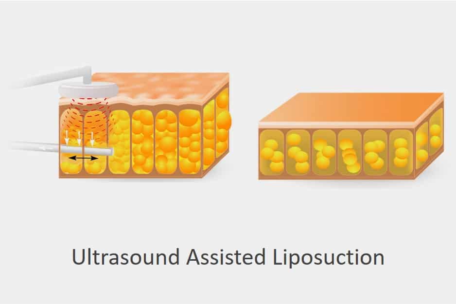 ultrasound assisted liposuction singapore