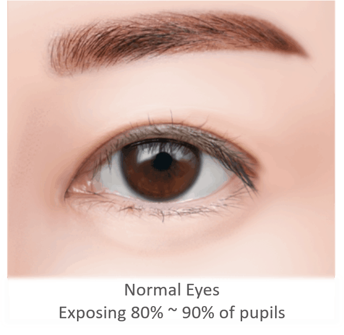 what causes ptosis and treatment
