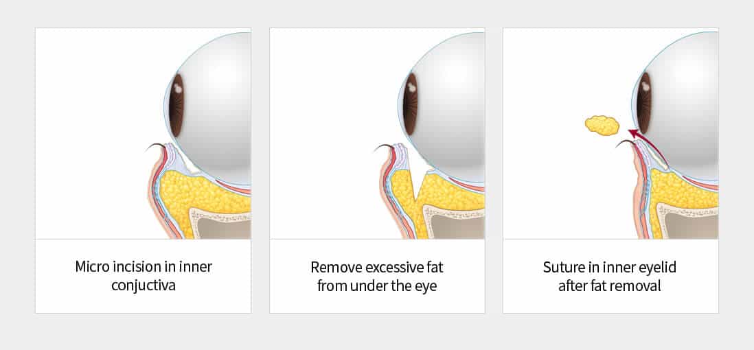 Transconjunctiva Eye Bag Removal Singapore