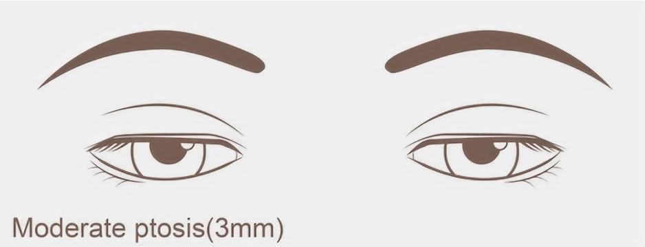 ptosis condition moderate