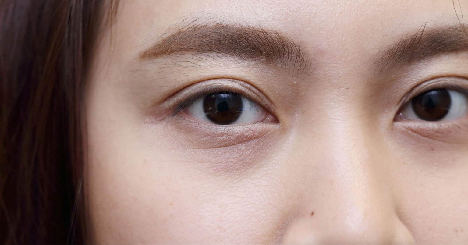 how to treat sunken eye bags