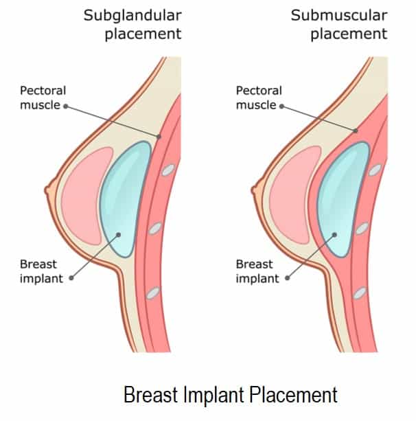 breast implant placement options