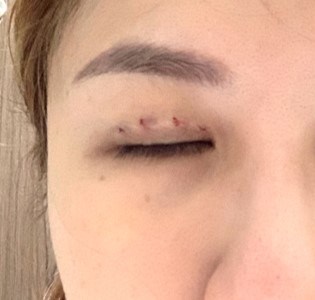 Double eyelid surgery clearance gone wrong