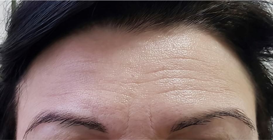 remove forehead wrinkles with fat grafting