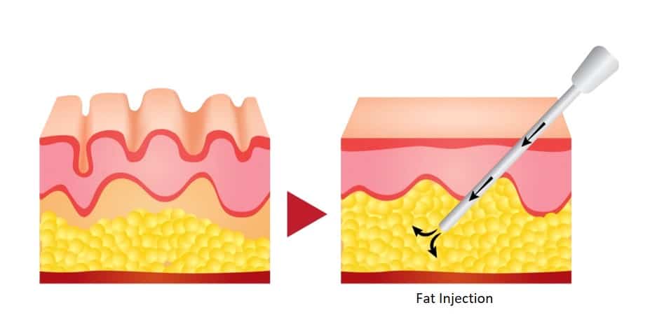 fat grafting injection in singapore