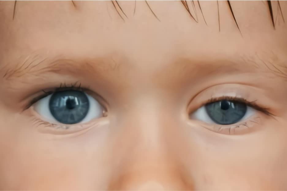 congenital droopy eyelids