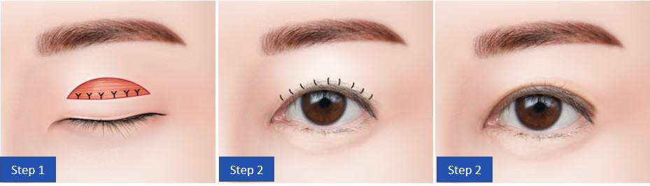 korean incisional double eyelid surgery method