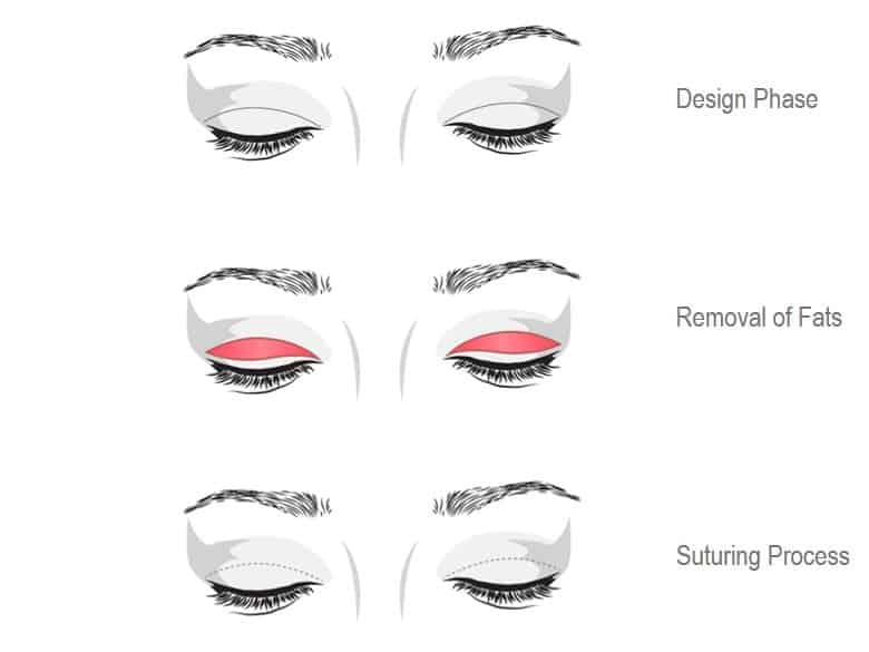 incisional double eyelid surgery method