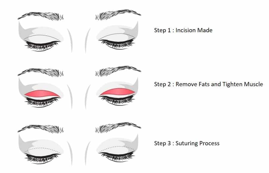 incisional upper eyelid surgery