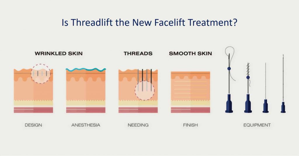 is threadlift the new facelift
