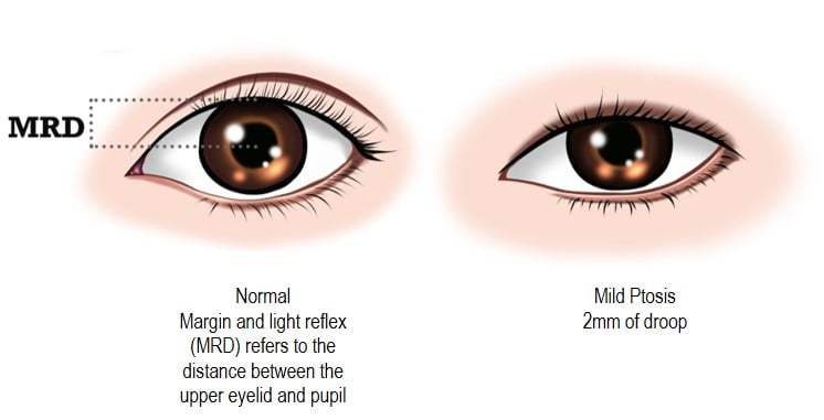 eye assessment for droopy eyelid condition