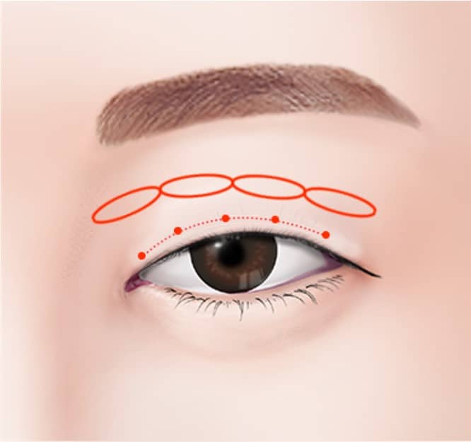 korean technique for non incisional double eyelid surgery