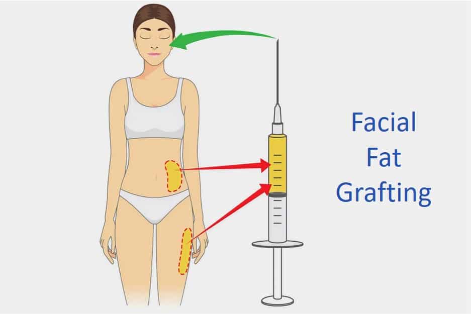 How fat grafting works- how fat injection works