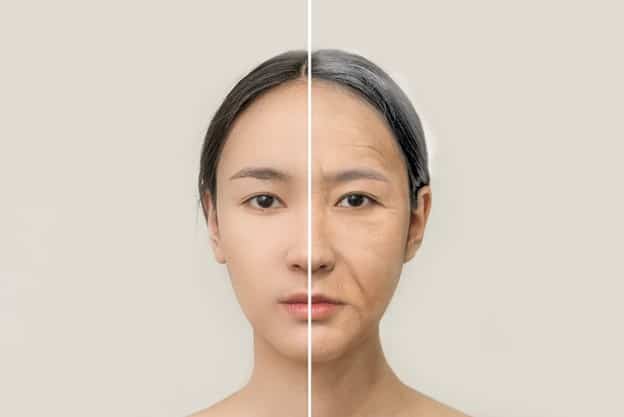 results after face fat grafting at dream plastic surgery singapore