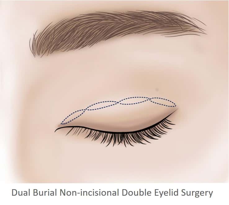 non cutting double eyelid surgery - suture double eyelid surgery at dream plastic surgery singapore